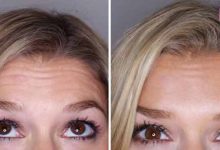 face botox before after