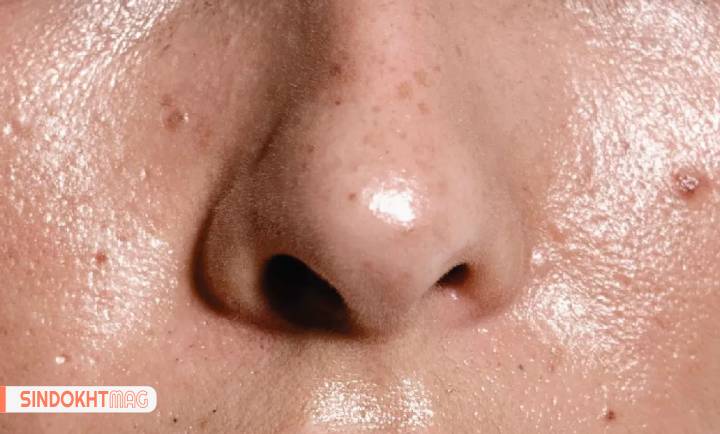 چطور بفهمیم پوست ما چرب است؟
